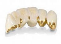 Металлокерамика в протезировании зубов