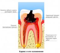 periodontit